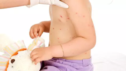 Bolile copilăriei - remedii naturale care sunt de ajutor