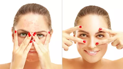 5 remedii naturale care te scapă de acnee