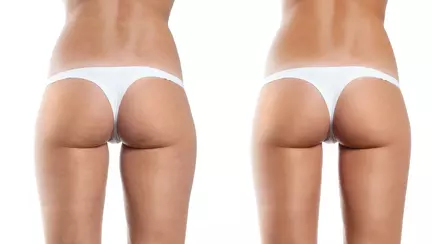 Remediu natural care elimină celulita
