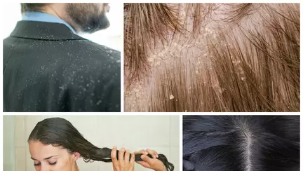 Cel mai simplu remediu natural pentru mătreaţă