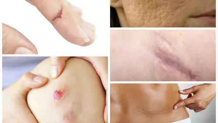 Cel mai bun cicatrizant natural