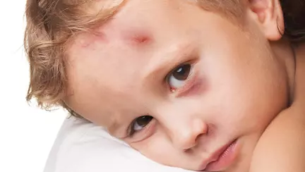 Ce am facut cand copilul meu s-a lovit la cap