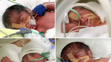 Cvadrupleții născuți la 26 de săptămâni, cântărind 650 de grame, au sfidat medicina