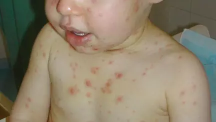 Cum să recunoști diferite erupții care apar la copii