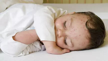 Povestea unui baietel nevaccinat care a facut varicela. Imaginile te vor lasa fara cuvinte