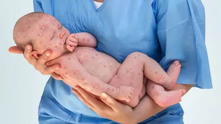 Simptomele rujeolei la copii. Cum arata bubitele | FOTO