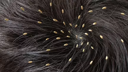 Cum previi infestarea cu paduchi