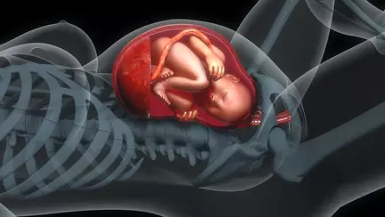 Placenta Accreta: Simptome, riscuri și tratament