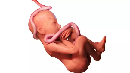 Circulara de cordon ombilical | Cordonul ombilical in jurul gatului