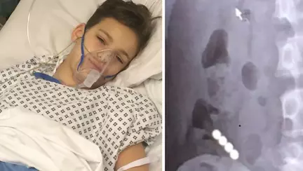 A inghitit patru magneti si a ajuns la spital in pericol de moarte