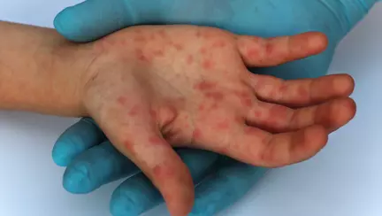 Cea mai cumplita complicatie a rujeolei: PESS (panencefalita sclerozanta subacuta)