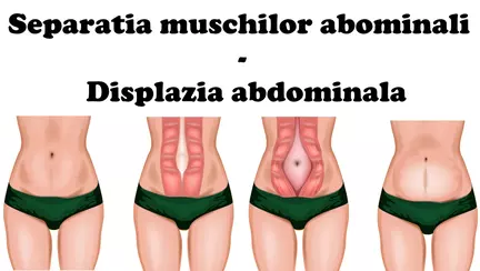 Burta dupa nastere: Displazia abdominala - Simptome si remedii