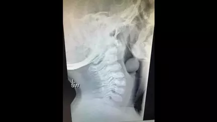 Boabele de struguri - O amenintare reala chiar si pentru copii mai mari