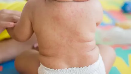 Exantemul subit (Roseola Infantum) - A sasea boala a copilariei