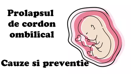 Prolapsul de cordon ombilical - Ce il cauzeaza si cum il eviti
