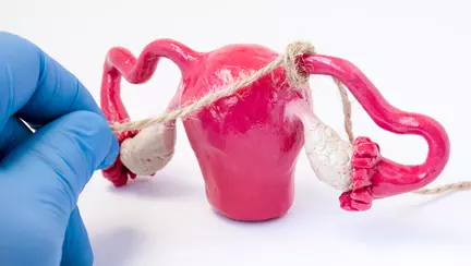 Ligaturarea trompelor uterine: avantaje si dezavantaje