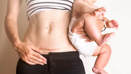 Cele 10 etape ale recuperarii prin cezariana