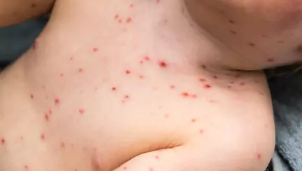 O mama a surprins diferenta dintre manifestarile varicelei cu si fara vaccin