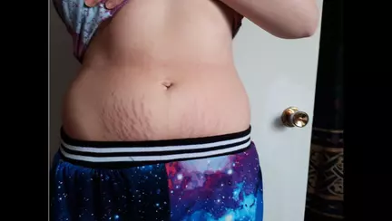 O mama sustine ca a descoperit cel mai bun tratament pentru vergeturi. Este gratuit