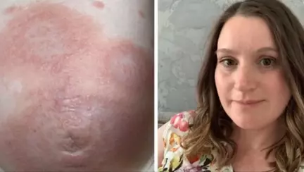 O femeie a descoperit că este alergică la propriul copil în timpul sarcinii