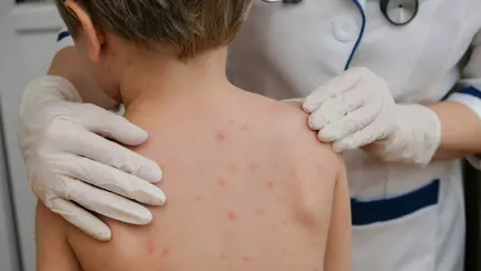 Un copil cu varicelă hemoragică a ajuns de urgență la Spitalul Victor Babeș din Timișoara