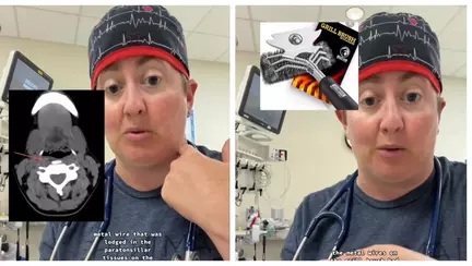 Un copil a ajuns la spital după ce a mâncat un hamburger. Ce au descoperit medicii în gâtul copilului