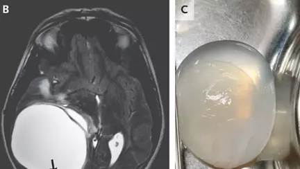 Unui adolescent care acuza dureri de cap și stări de vomă i s-a descoperit o tumoare uriașă pe creier
