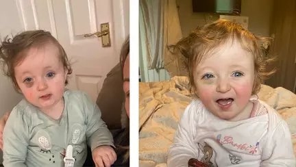 Diagnosticul primit de o fetiță căreia i-a apărut, din senin, o vânătaie sub ochi