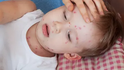 Cum se face testul paharului pentru a depista afecțiunile grave ale copilului febril cu erupții pe piele