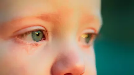 Medicul pediatru Mihai Craiu, despre afecțiunile ochilor asociate sezonului cald. "La plajă, în locurile de joacă pentru copii"