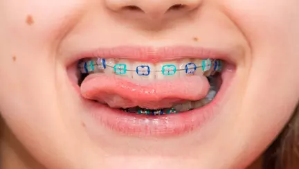 Semnele care indică necesitatea unui tratament ortodontic la copilul tău: Sfaturi de la specialiștii Dentus•Dentino