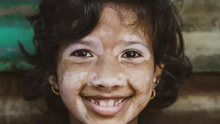 Cauți un tratament pentru vitiligo cu rezultate clare? Terapia pe bază de IgY de tip aviar e răspunsul