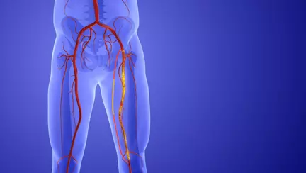 Boala arterială periferică: simptome și soluții chirurgicale moderne