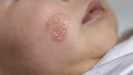 Infecțiile fungice ale pielii: diagnostic rapid în cabinetul de dermatologie