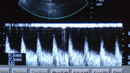 Placenta previa - Ce este, care sunt simptomele și cum se tratează