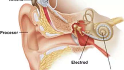Implant auditiv pentru nou-nascuti