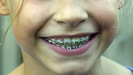 Unul din doi copii are nevoie de aparat dentar