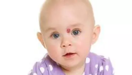 Semnele din nastere - periculoase sau nu?