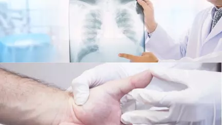 Semnele apărute la nivelul mâinilor care pot anunța cancerul pulmonar. Schimbările pe care trebuie să le iei în calcul