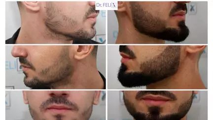 Barbă rară sau neuniformă? Ce trebuie să știi despre transplantul de barbă și prețul acestuia?
