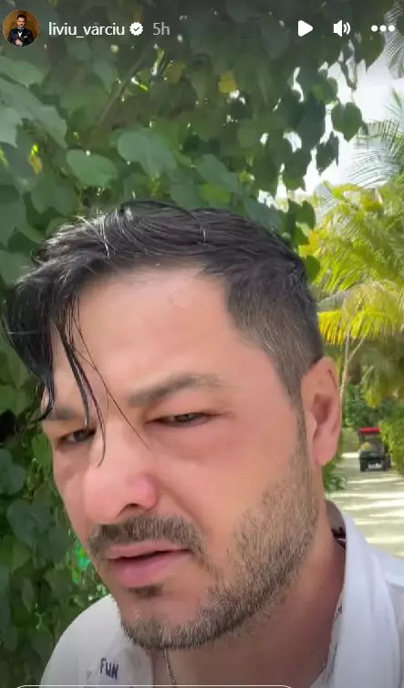 liviu-varciu-s-a-trezit-cu-fata-umflata-in-vacanta-1