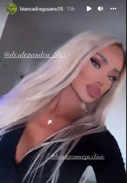 Bianca-Dragusanu-a-apelat-la-o-noua-interventie-estetica-2