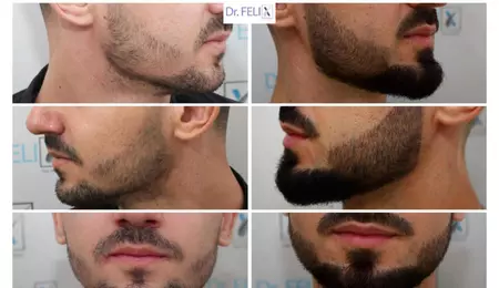 Barbă rară sau neuniformă? Ce trebuie să știi despre transplantul de barbă și prețul acestuia?