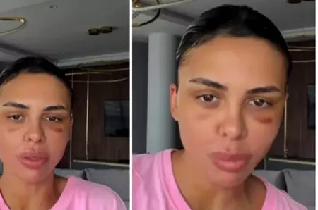 Ce operații estetice și-a făcut Andreea Popescu după divorțul de Rareș Cojoc! „Mi-a căzut părul enorm”. Fanii nu o mai recunosc!