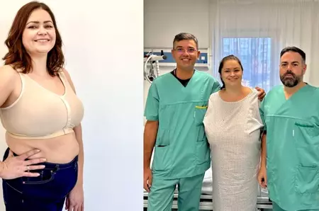 Cazul impresionant al femeii care suferea de gigantomastie. Cum a ajuns de la cupa F la cupa C. „Sânii imenși deveniseră o povară!”