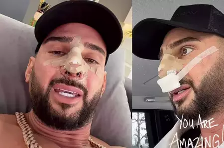 Dorian Popa a fost operat de urgență la nas, iar intervenția a durat 6 ore: "Mi-a scos o bucată de vreo 5 centrimetri din coastă, ca să poată repara tot"