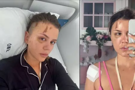 Emily Burghelea a răbufnit după ce Radu Ciucă a acuzat-o că și-a înscenat accidentul din Mauritius: "Am purtat săptămâni întregi o atelă metalică în cap și am petrecut o lună întreagă fără să îmi pot lua copiii în brațe"