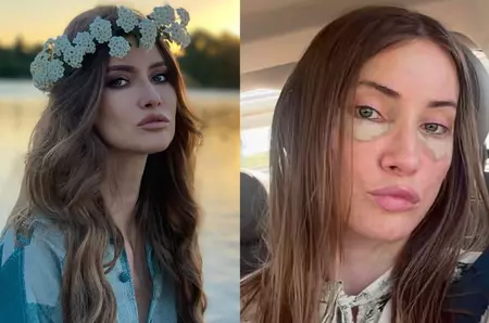 Iulia Albu și-a făcut lifting facial, la 44 de ani. Cum arată după operația estetică: „Procedura a reprezentat primul pas, urmat de un protocol de recuperare, perfuzii și tratamente”