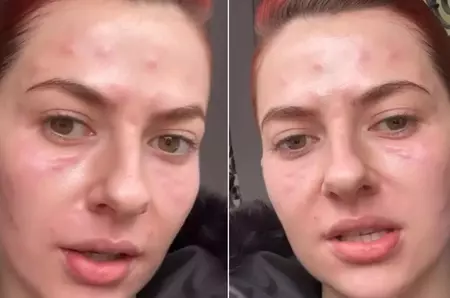 Lidia Buble, imagini îngrijorătoare. Cântăreața a apărut cu pielea umflată și roșie: „Am fața amorțită”. Ce a pățit