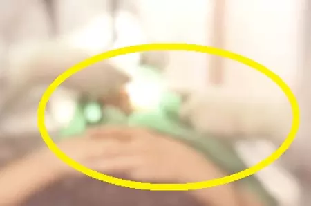 Anestezia generală la dentist: când este cu adevărat necesară